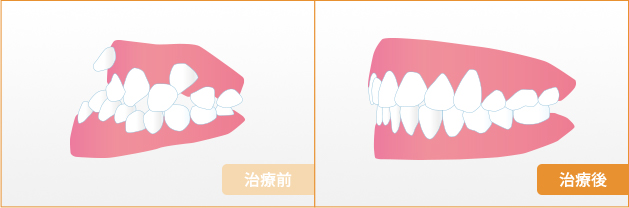 下顎前突受け口